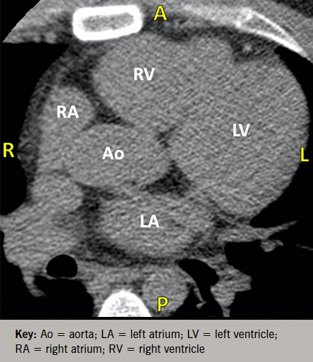 Sheppard - Figure 1. Axial cardiac computed tomography (CT) image demonstrating zero detectable calcium burden