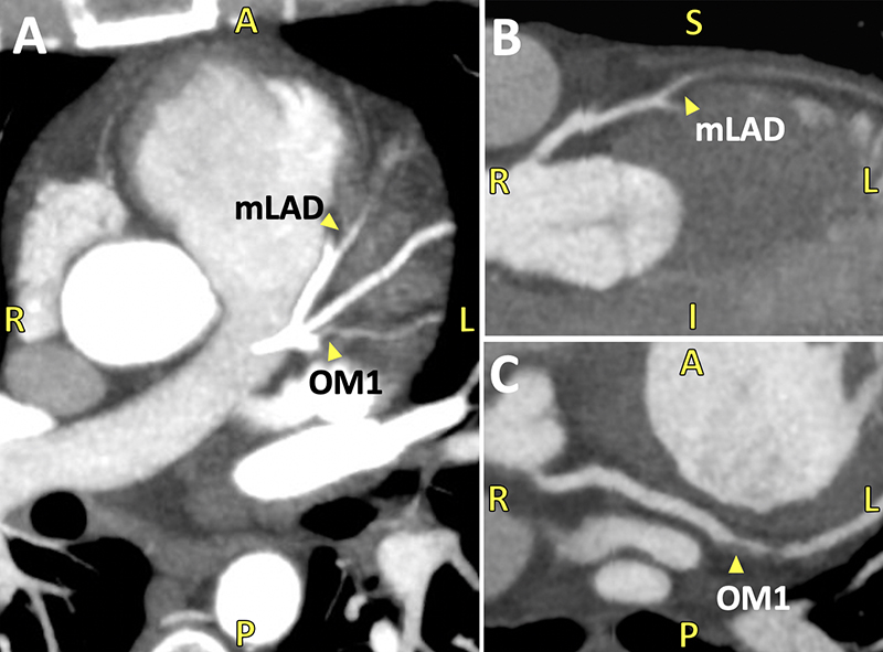 Sheppard - Figure 2. A. Axial CT angiography image demonstrating occlusions of the mid-left anterior descending (mLAD) and first obtuse marginal (OM1). B. Mid-LAD total occlusion in coronal view. C. OM1 occlusion in axial view