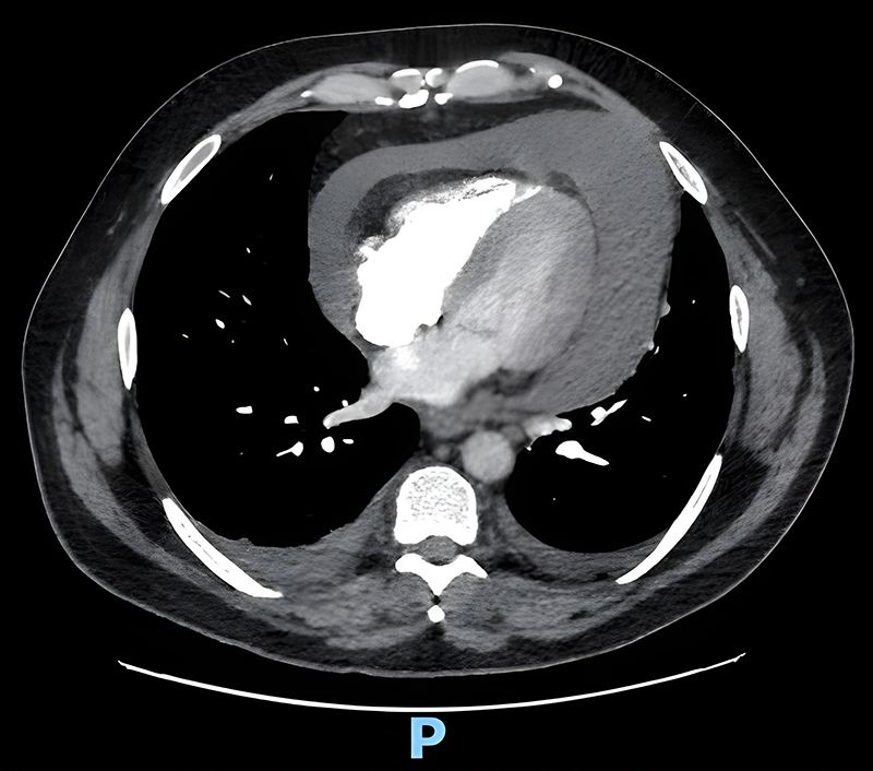 Meah - Figure 3. Computed tomography pulmonary angiogram (CTPA): moderate-large pericardial effusion, small bilateral pleural effusions