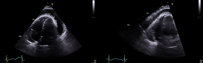 Meah - Figure 4. Echocardiogram prior to pericardiocentesis. Measurements: 2.3–3.8 cm anteriorly, 1.5 cm posteriorly, 3.4 cm laterally, 3.9–4.3 cm apically and 2.2 cm behind the right atrium