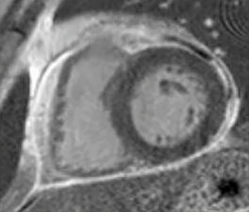 Meah - Figure 5. Cardiac magnetic resonance imaging: short-axis delayed enhancement image with Gadovist demonstrating circumferential pericardial enhancement