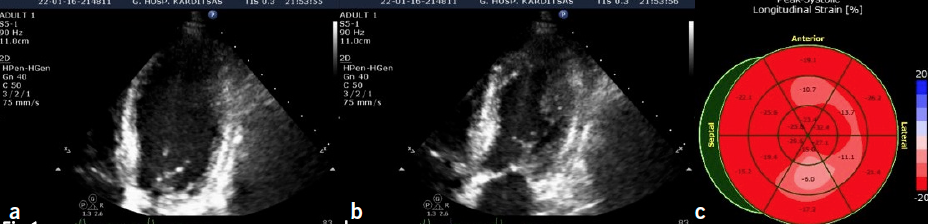 Nikias - Figure 1. 2D echocardiographic still images of the apical four-chamber view of the heart focusing on the left ventricle (LV) in: diastole (a) and systole (b) showing akinesis (no systolic thickening) of the mid-diaphragmatic and mid-lateral segments of the LV; (c) mildly abnormal global longitudinal strain, especially of the mid-ventricular segments