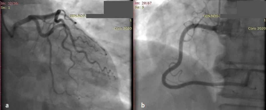 Nikias - Figure 2. Basic views on coronary angiography: right anterior oblique (RAO) caudal view of the left coronary system without significant stenoses (a) and RAO cranial view of the right coronary system without stenoses (b)