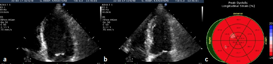 Nikias - Figure 3. 2D echocardiographic still images of the apical four-chamber view of the heart focusing on the LV: in diastole (a) and systole (b) showing normal systolic thickening of the previously affected segments; (c) normal global longitudinal strain