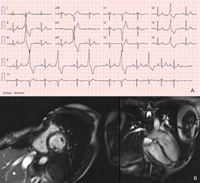 Ferraz - Figure 1. A. 12-lead electrocardiogram showing ventricular extrasystole. B. Cardiac magnetic resonance study revealing severe pectus excavatum with compression and deformation of the right cardiac chambers