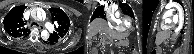 Booth - Figure 4. Computed tomography (CT) images of type A aortic dissection. From left to right: type A aortic dissection axial view, type A aortic dissection coronal view, type A aortic dissection sagittal view. All demonstrate the creation of a new false lumen within the vessel as a result of the dissection