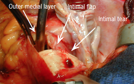 Booth - Figure 1. Intra-operative picture of an aortic dissection, once the aorta has been opened, surgeon’s view