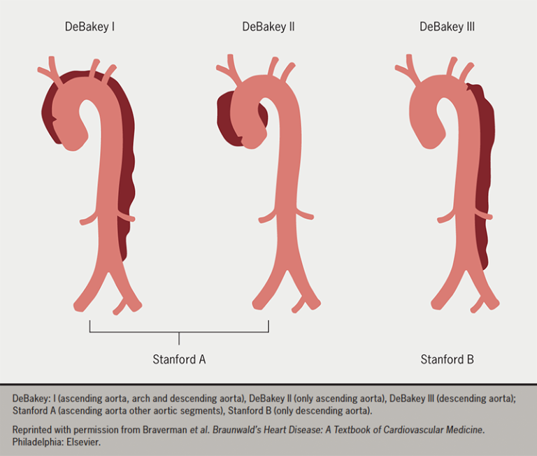 Acute Aortic Dissection (AAD) – A Lethal Disease: The Epidemiology ...