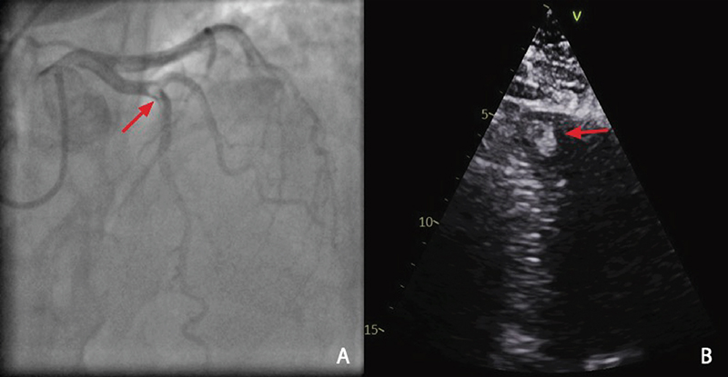 Somma - Figure 1. A. Posteroanterior (PA) cranial projection of the left coronary system. Filling defect (see arrow) at the mid-vessel of the left anterior descending (LAD) at the first diagonal bifurcation (likely thrombus). B. An off-axis apical four-chamber view. There was severe apical akinesis with an estimated left ventricular (LV) ejection fraction of 45%. There is an echogenic mass (see arrow) seen in the LV apex measuring 2.2 × 1.3 cm, suggestive of thrombus