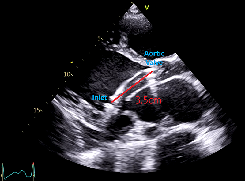 Akhtar - Figure 2. Correct Impella positioning on transthoracic echocardiography, parasternal long-axis view