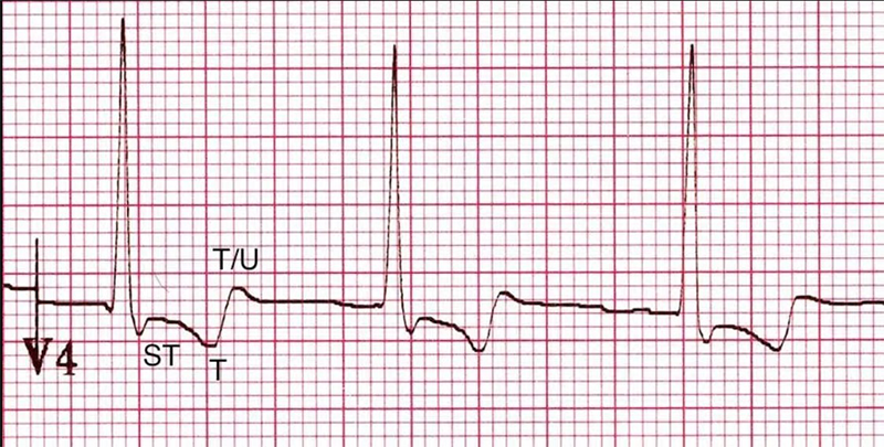 BJC Learning Digoxin - Figure 4. ECG of the typical “reverse tick” of digoxin effect