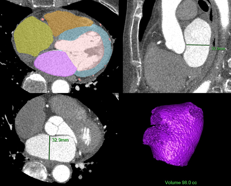 Kitchen - Figure 1. Data extraction from coronary computed tomography angiography imaging. Top left: Fully automated method of obtaining left atrial volumes and left ventricular mass. Top right: Measurement of the anterior-posterior diameter of the midline of the left atrium in the middle 50% from sagittal view. Bottom left: Measurement of the anterior-posterior diameter of the midline of the left atrium in the middle 50% from axial view. Bottom right: Virtual three-dimensional rendering of left atrium derived from a fully automated method of obtaining cardiac chamber volumes