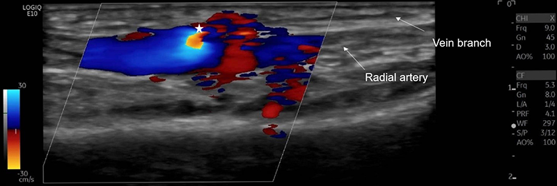 Sadler - Figure 2. Colour Doppler ultrasound of the right wrist showing a 1.7 mm communication between a dilated (4.5 mm) radial artery and the distal cephalic vein branch (indicated by star)