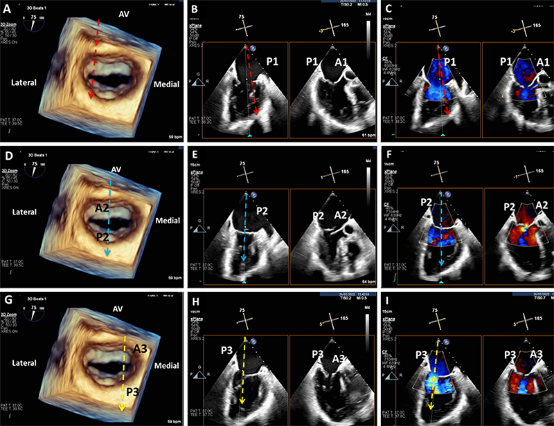 Blackman - Figure 2. Mitral valve segmental analysis. A ‘surgical 3D view’ of the mitral valve is shown and illustrates where the cursor (dashed line) of the simultaneous multi-plane image is traversing the aspect of the commissural line of the mitral valve (images A, D and G). Directing the cursor of the simultaneous multi-plane through the relevant scallop on the optimised bi-commissural view in the primary image depicts the corresponding orthogonal long-axis view of the scallops in the secondary image (images B, E and H). The same image with colour Doppler is shown (images C, F and I) to illustrate the jet characteristics. In this case a flail P2 scallop with a large conversion zone is seen due to the regurgitation through the flail P2 scallop