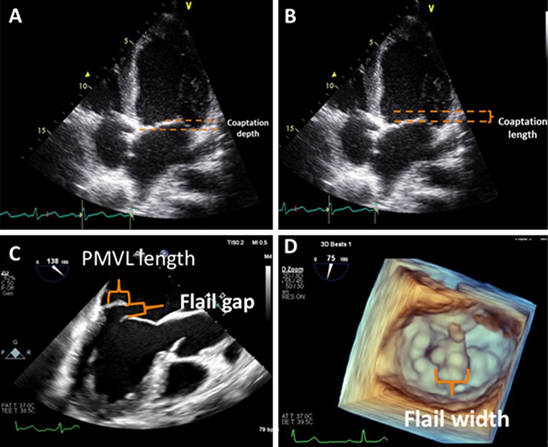 Blackman - Figure 3. In degenerative mitral regurgitation (DMR) the flail gap is best measured in the long-axis view (or where the flail gap is greatest) in systole. The mobile leaflet length is measured usually in long-axis either in systole or in mid-diastole (A). The flail width is usually either measured in mitral valve short-axis view in systole or on the 3D en-face view as depicted in image B. In functional mitral regurgitation (FMR) the coaptation depth and coaptation length are best measured in the four-chamber or long-axis view in systole (C and D)