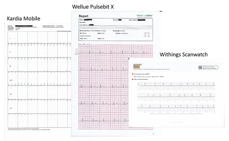 Volucke - Figure 1. Examples of electrocardiogram (ECG) recordings by patients sent for review by email