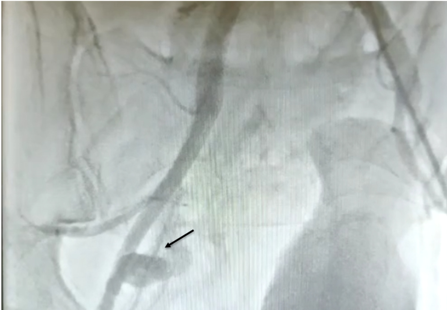 Shah - Figure 1. Right femoral angiogram showing extravasation of contrast confirming diagnosis of active bleeding