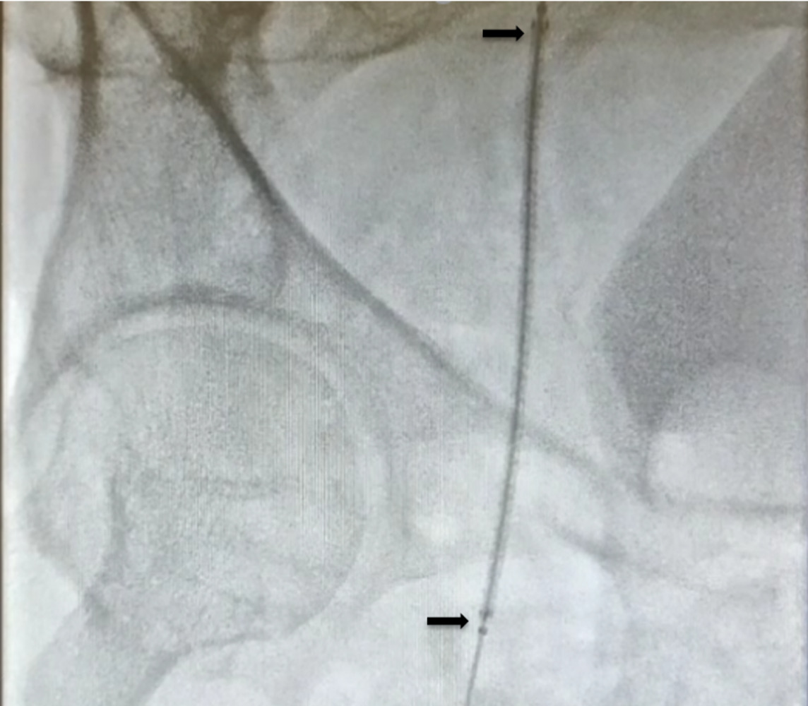 Shah - Figure 2. Fluoroscopy showing positioning of covered stent prosthesis in right femoral artery