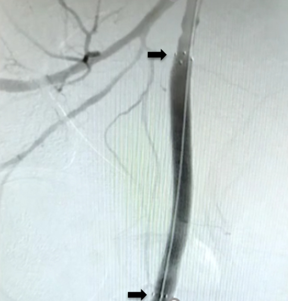 Shah - Figure 3. Digital subtraction angiography showing satisfactory haemostasis with covered stent prosthesis (black arrows represent the proximal and distal ends of the stent prosthesis)