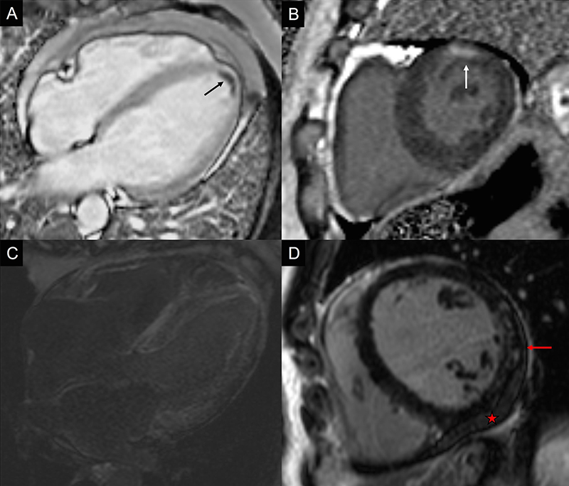 Hampal - Figure 1. Examples of cases where cardiovascular magnetic resonance (CMR) changed the patient management. A. A 36-year-old man presenting with anterior myocardial infarction. A small left ventricular (LV) thrombus is demonstrated (black arrow). B. A 56-year-old woman presenting with chest pain and unobstructed coronary arteries on coronary angiogram. A small infarct is demonstrated (white arrow), suggestive of an embolic event or small-branch vessel infarction. C. A 72-year-old man with a background of ischaemic heart disease. CMR showed abnormal gadolinium kinetics and extensive enhancement suggestive of cardiac amyloid. D. A 49-year-old man presenting with breathlessness and raised troponin. Coronary arteries were unobstructed. There is patchy late gadolinium enhancement of the lateral wall (red arrow) and a small pericardial effusion (star) suggestive of a myopericarditis