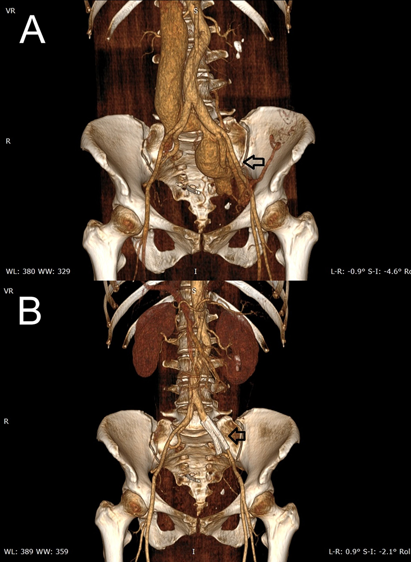 Sánchez-Amaya - Figure 2. Computed contrasted angio-tomography, 3D reconstruction, coronal view. A. A large peripheral arteriovenous fistula (AVF) is seen (black arrow). 
B. Previous AVF has been corrected after intravascular stent placement (black arrow)