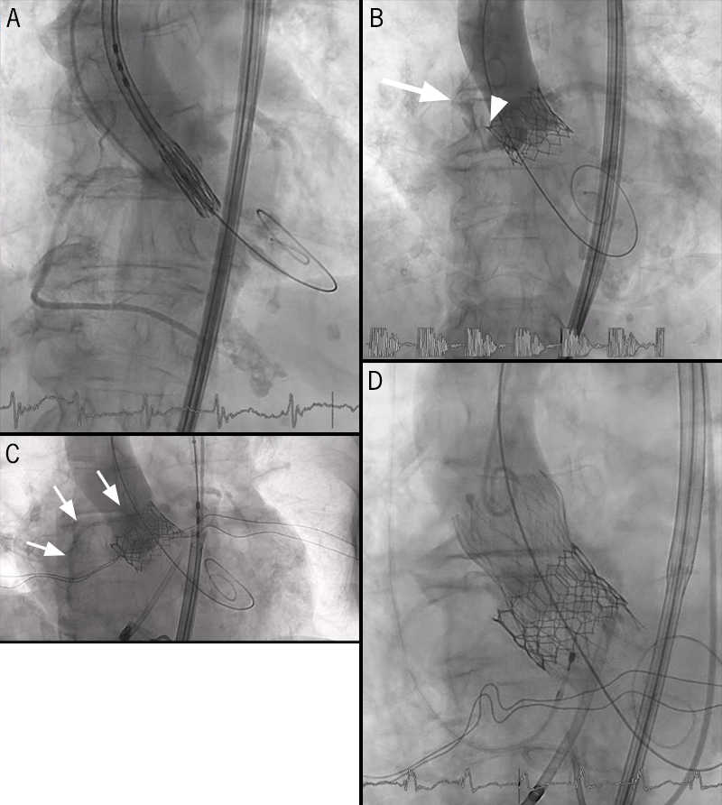 Rocha - Figure 1. A. Transcatheter aortic valve implantation (TAVI) positioning. B. Fluoroscopy showing contrast retention (arrow) outside the aorta and prosthetic valve skirt protusion on the aortic valve (arrow head) without right coronary artery contrast fill. C. Aortography after post-dilation already with right coronary artery visualisation (arrows). D. Valve-in-valve good final result