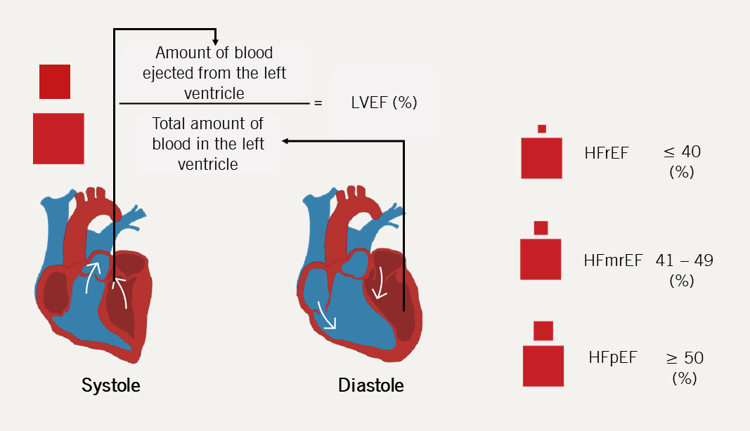 Heart failure module 1 - Figure 8. Infographic of the phenotypic classification of HF according to left ventricular ejection fraction