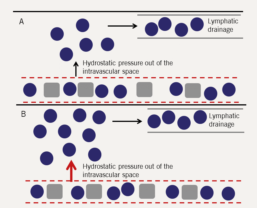 Heart failure module 1 - Figure 9. Increased hydrostatic pressure resulting in transudation into the intravascular space, resulting in increased fluid accumulation