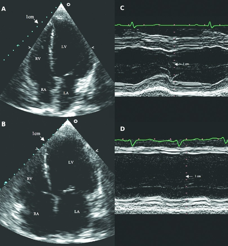 Heart failure module 2 - Figure 21. Apical four-chamber diastolic view of two-dimensional echocardiograms and M-mode echocardiograms of the LV recorded in a normal subject (A, C) and a patient with dilated cardiomyopathy (B, D). In the patient with dilated cardiomyopathy, the LV is greatly enlarged and its function reduced