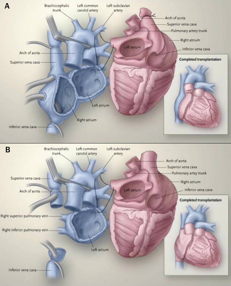 Heart failure module 5 - Figure 5. Evolving surgical technique, with the donor organ in red, recipient structures in blue, and surgical instruments in grey. Panel A shows the biatrial technique where the recipient right atrium remains in situ necessitating a long atrial anastamosis but retaining more normal haemodynamics with native structures. Panel B shows the bicaval technique, where the recipient right atrium is removed and great veins anastamosed to the donor atrium