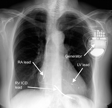 Heart failure learning module 4: Invasive treatment of HF