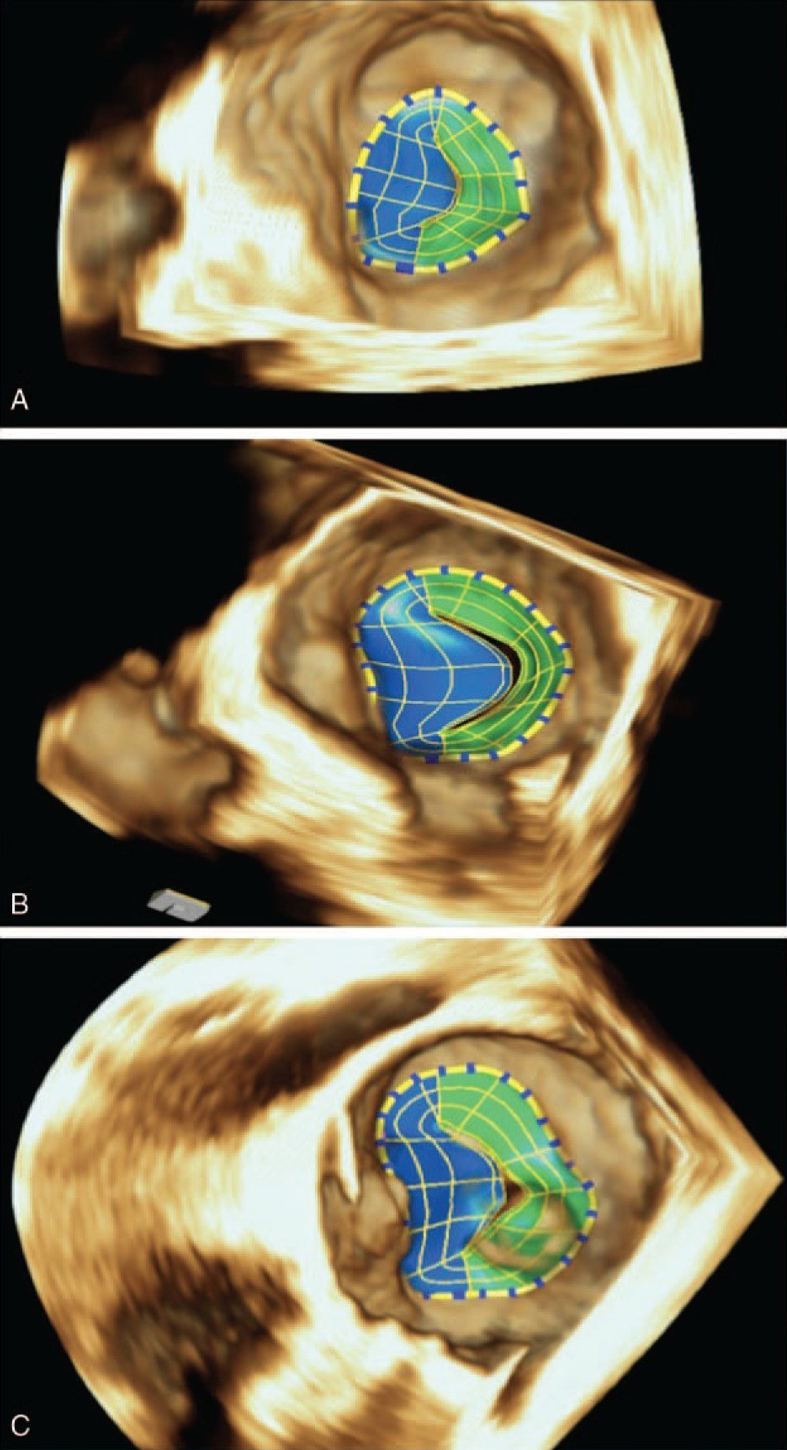 Bamford - Figure 1. Software mitral valve reconstruction in a normal patient (A), secondary mitral regurgitation (MR) (B), and primary mitral valve patient (C). In secondary MR, mitral annulus contractility decreases as it loses its saddle shape and becomes dilated and flattened, in primary MR the mitral annulus enlarges despite preserved mitral annulus function