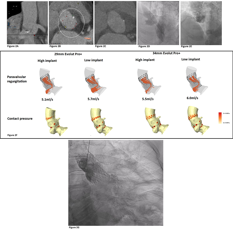 Bamford - Figure 2. Procedural planning and deployment of 29 mm EvolutTM Pro+ (Medtronic plc.) TAVI in a patient with LVOT aneurysm. A. LVOT aneurysm viewed on CT TAVI (arrow = LVOT aneurysm). B. Aortic annulus measurements with unclear border due to LVOT aneurysm. C. LVOT viewed on CT at 3 mm from annulus. D. Left ventriculography demonstrating LVOT aneurysm. E. Aortogram demonstrating no supra-annular involvement of aneurysm. F. FEops HEARTguideTM computer simulations predicting paravalvular leak and contact pressure from 29 mm and 34 mm EvolutTM Pro+ (Medtronic plc.) at different implant depths. G. Aortogram demonstrating trivial aortic regurgitation following deployment of 29 mm EvolutTM Pro+ (Medtronic plc.)