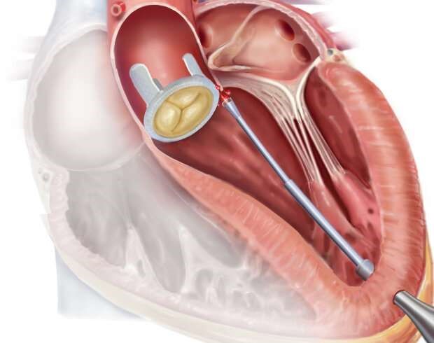 Bamford - Figure 3. An automated catheter using haptic vision relying on contact pressure and image interpretation to guide its path