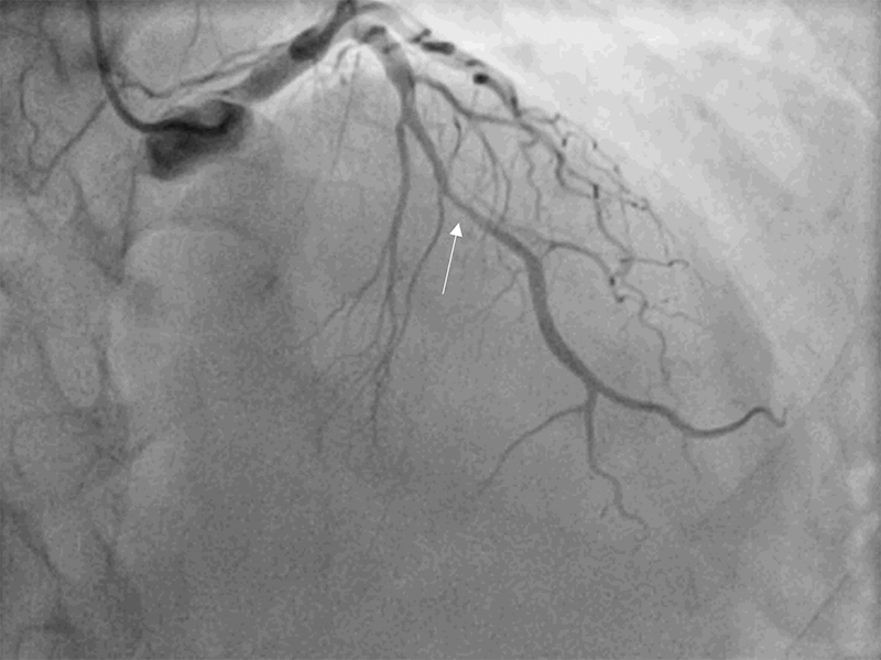 Ferreira - Figure 1. Left coronary angiography showing an image compatible with a spontaneous coronary artery dissection type 2 characterised by diffuse long smooth tubular lesions (due to intramural haematoma) with no visible dissection plane that can result in complete vessel occlusion (arrow)