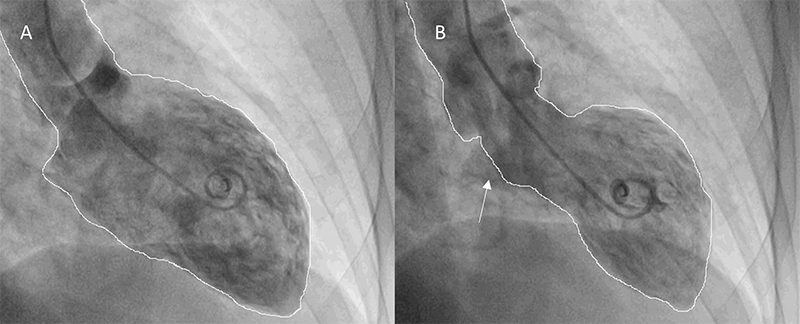 Ferreira - Figure 2. A. Ventriculography during left ventricular diastole. B. Ventriculography during left ventricular systole showing hypercontractility of the basal segments (arrow) with akinesia of middle/distal walls compatible with Takotsubo syndrome