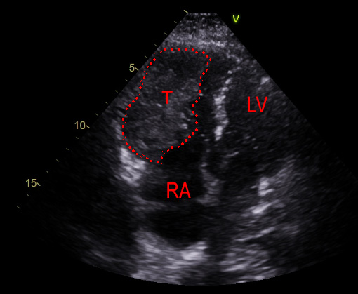 Shahid - Figure 1. Apical four-chamber view on echocardiography, showing the tumour (T) in the right ventricle. Also shown is the left ventricle (LV) and right atrium (RA)