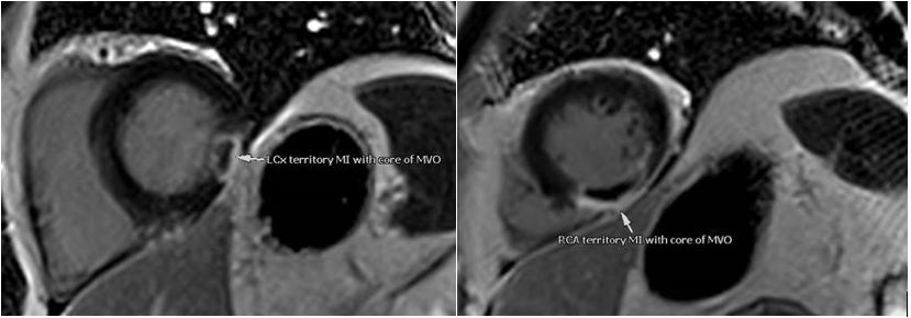 Khan - Figure 2. Cardiac magnetic resonance imaging (CMR) showing thromboembolic infarcts in the left circumflex and right coronary artery (RCA) territories