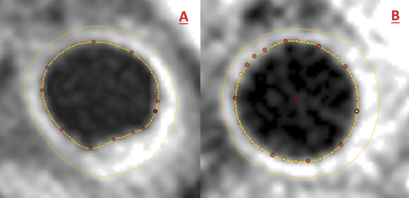 Khan - Figure 3. Cross-sectional carotid CMR with overlying internal and external carotid wall contours depicting plaque regression in a patient with raised Lp(a) and HeFH before (A) and after (B) three months of LA