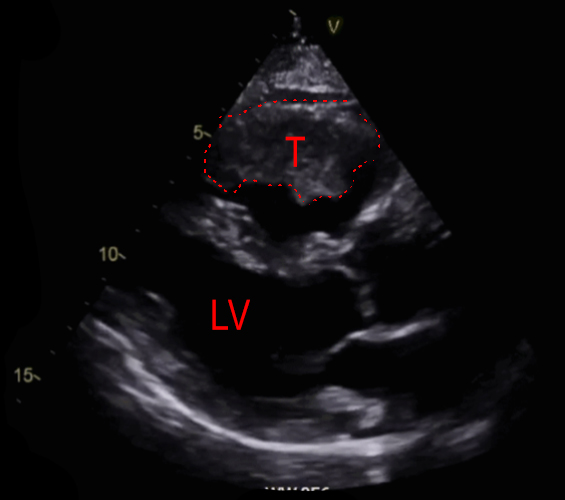 Shahid - Figure 2. Parasternal long-axis view on echocardiography showing tumour (T) in right ventricle. Also shown is the left ventricle (LV)