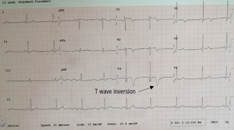 Zaman - Figure 2. Electrocardiogram demonstrating features consistent with temporary left anterior descending (LAD) coronary artery ischaemia (Wellen’s syndrome)