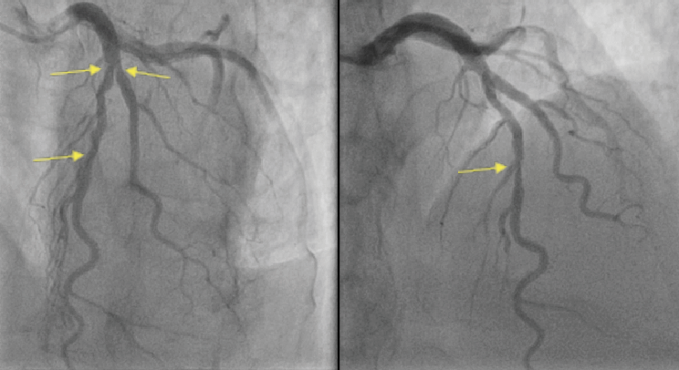 Zaman - Figure 3. Coronary angiogram demonstrating severe LAD coronary artery disease