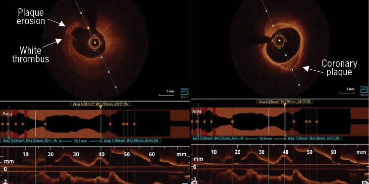 Zaman - Figure 4. Optical coherence tomography (OCT) demonstrating plaque erosion in the mid-LAD with an adherent white thrombus