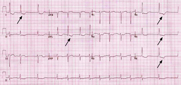 Andrews - Figure 1. An electrocardiogram showing the ‘reverse-tick’ appearance of the ST-segment associated with digoxin use (indicated by the arrows)