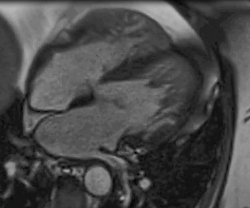 Parameswaran - Figure 2. Cardiac magnetic resonance imaging of case 1, showing hypertrabeculation of the left ventricle