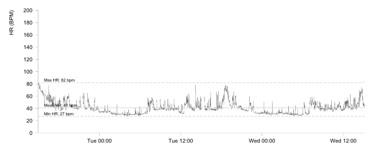 Parameswaran - Figure 3B. Rate histogram from case 1.