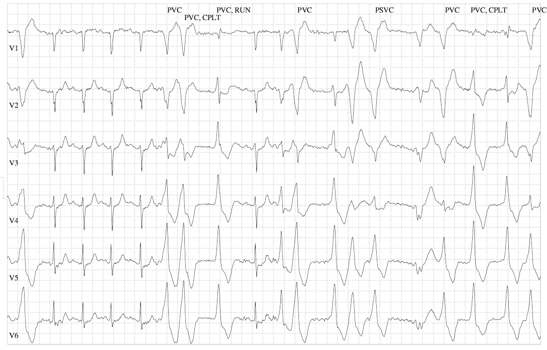 Parameswaran - Figure 3C. Exercise test tracing from case 1 showing frequent ventricular ectopics and three beat runs of non-sustained ventricular tachycardia.