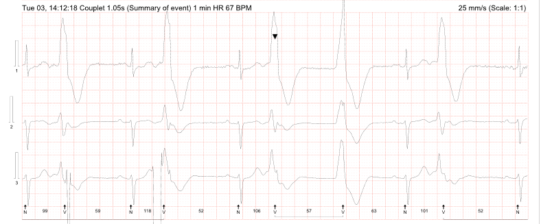 Parameswaran - Figure 3D. Bigeminy and ventricular couplet during ambulatory monitoring in case 1.