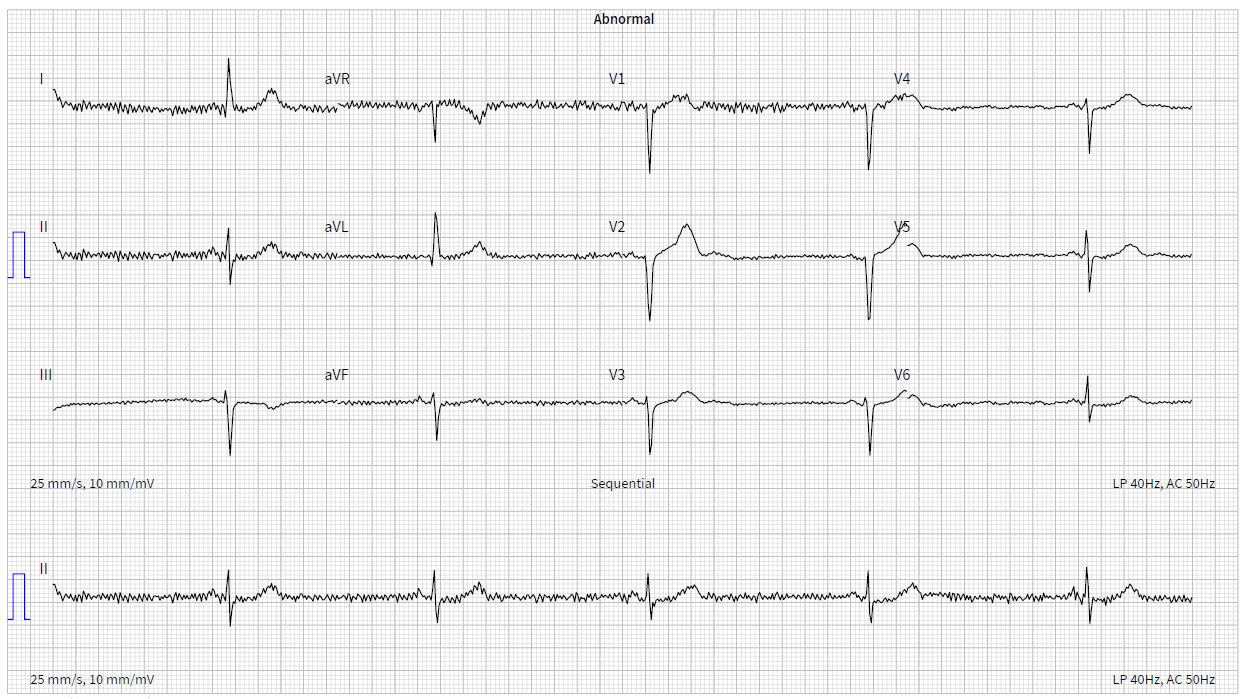 Parameswaran - Figure 3E. Resting 12-lead ECG from case 2.