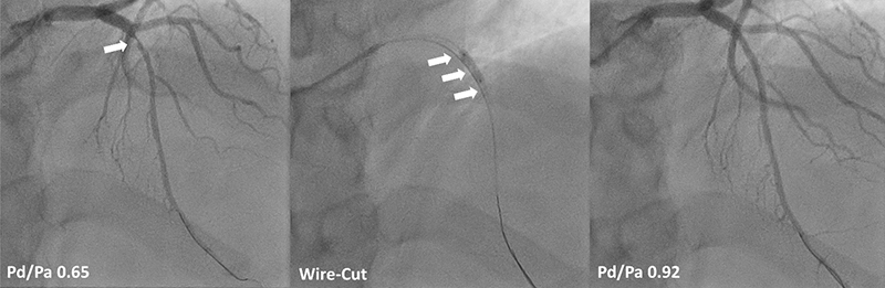 Lim - Figure 1. Drug-coated balloon and the left anterior descending (LAD) artery. Coronary angiogram image shows a tight mid-LAD artery lesion in a 50-year-old man with an acute coronary syndrome, pressure-wiring found that the plaque was highly flow limiting with a low aortic-to-distal coronary artery pressure gradient, Pd/Pa (left panel). The LAD was dilated with the force-focused double buddy-wire cutting technique for controlled dissection, followed by drug-coated balloon treatment (middle panel). Final result with normalisation of flow (right panel)